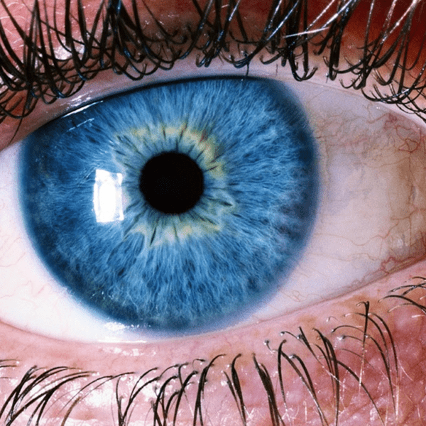 Inherited Retina Diseases thumbnail