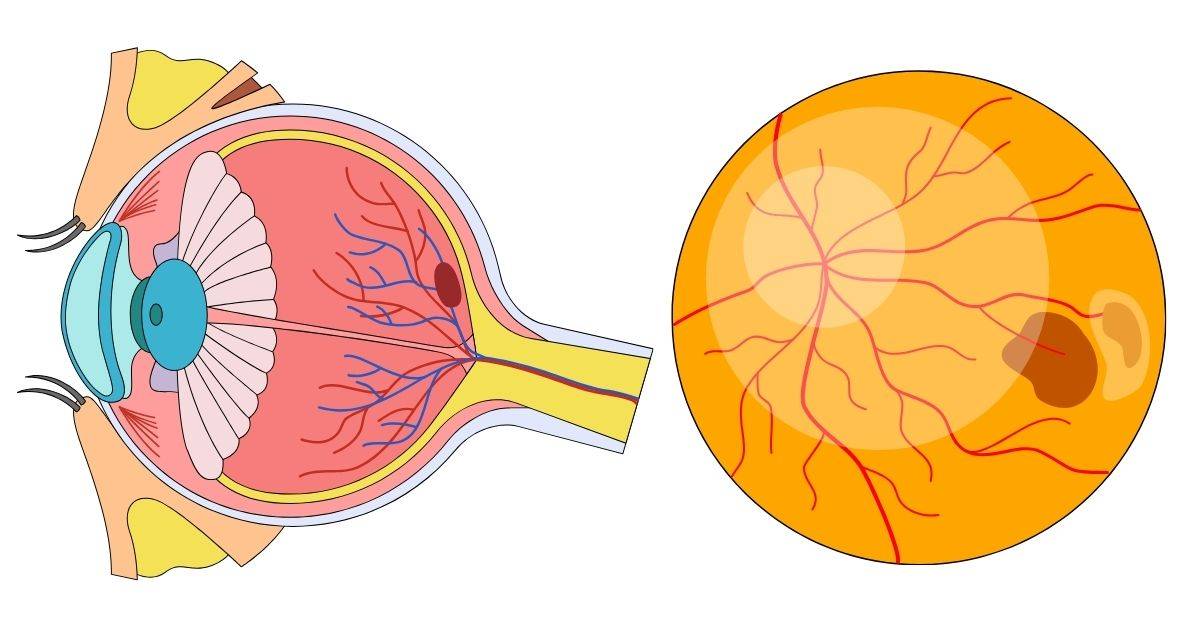 What Is an Epiretinal Membrane? thumbnail
